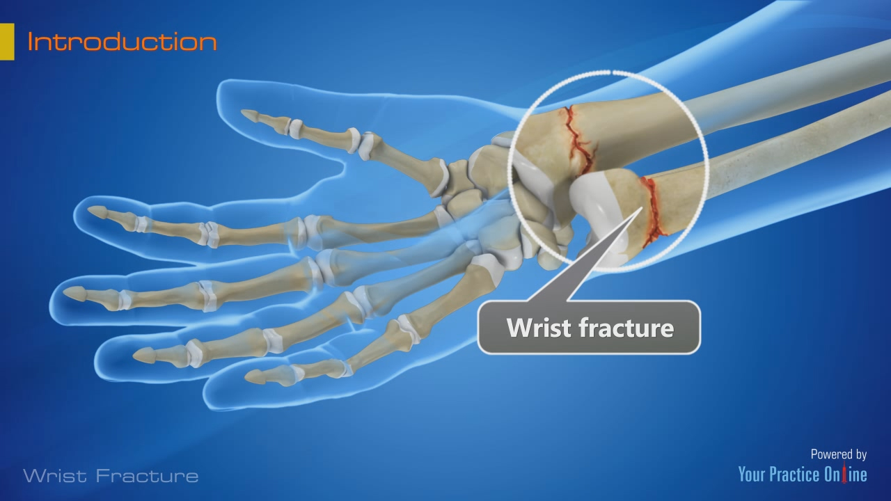 2 Commonly Broken Wrist Bones In Left Afrm