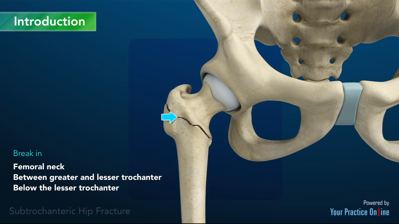 femoral neck vs intertrochanteric fracture