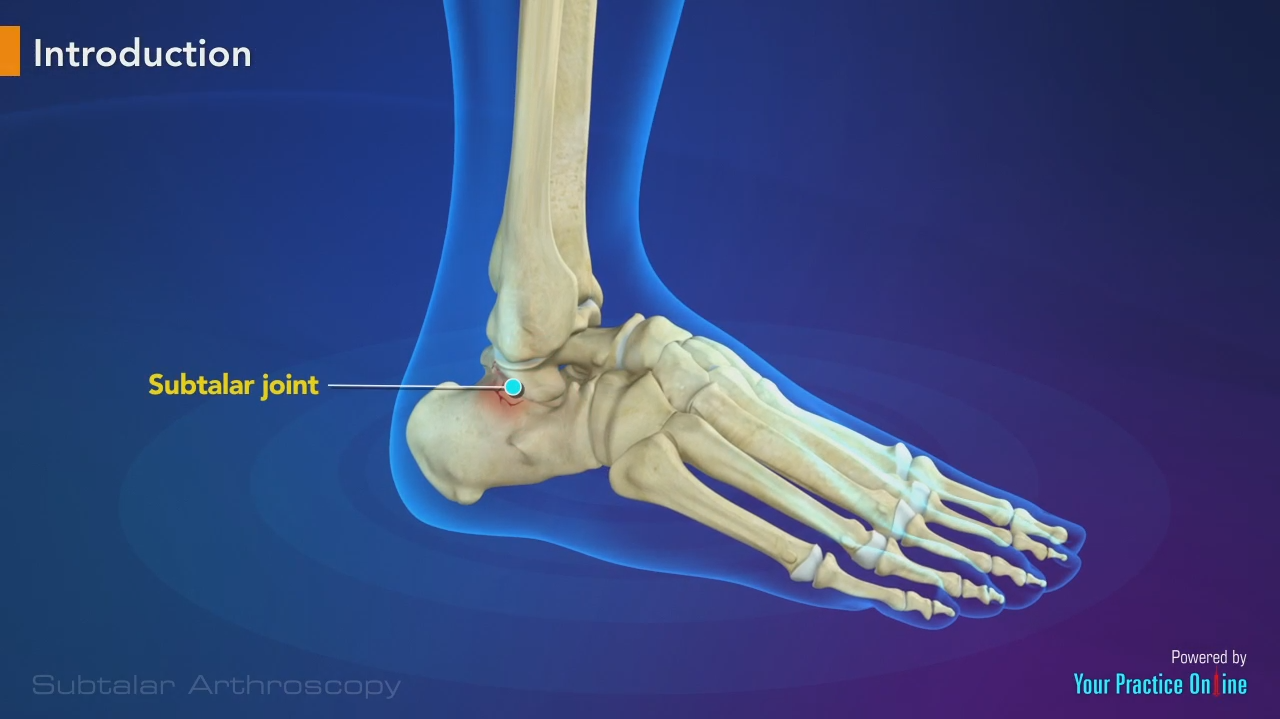 Arthrotomy Ankle
