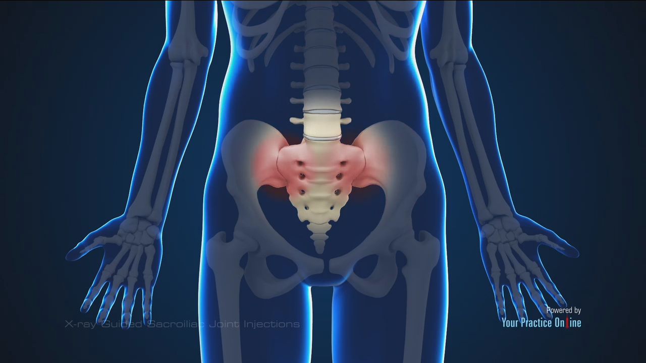 What about Sacroiliac Joint Pain and Injection?