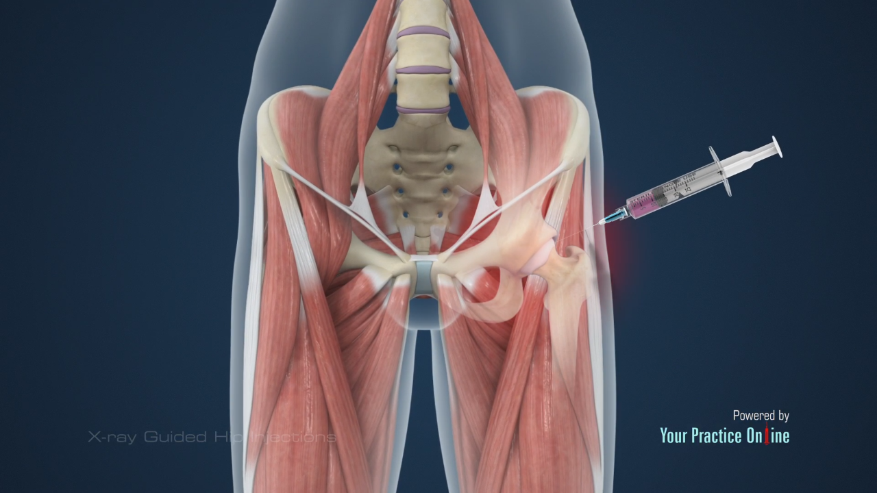 injection in hip
