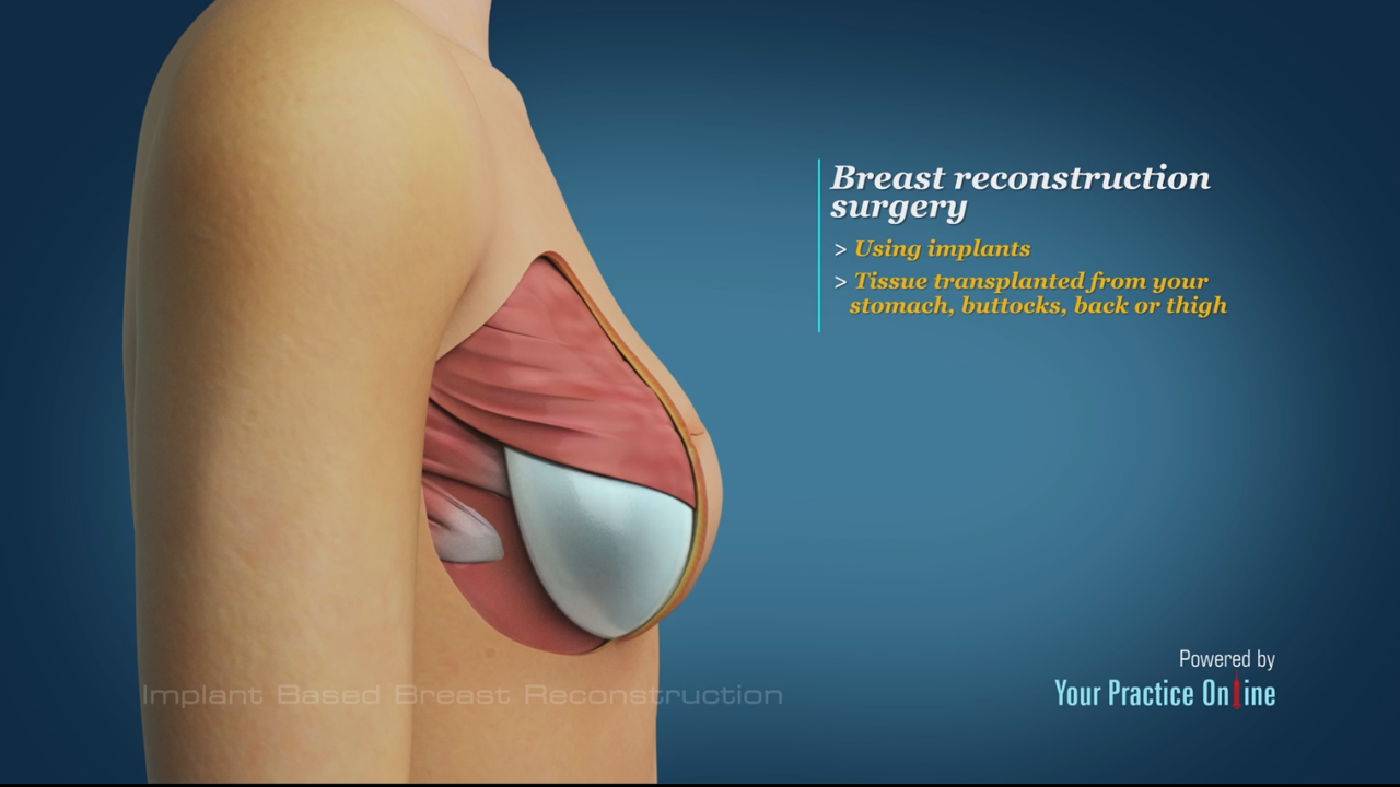 Breast Augmentation Post-Operative Patient Instructions