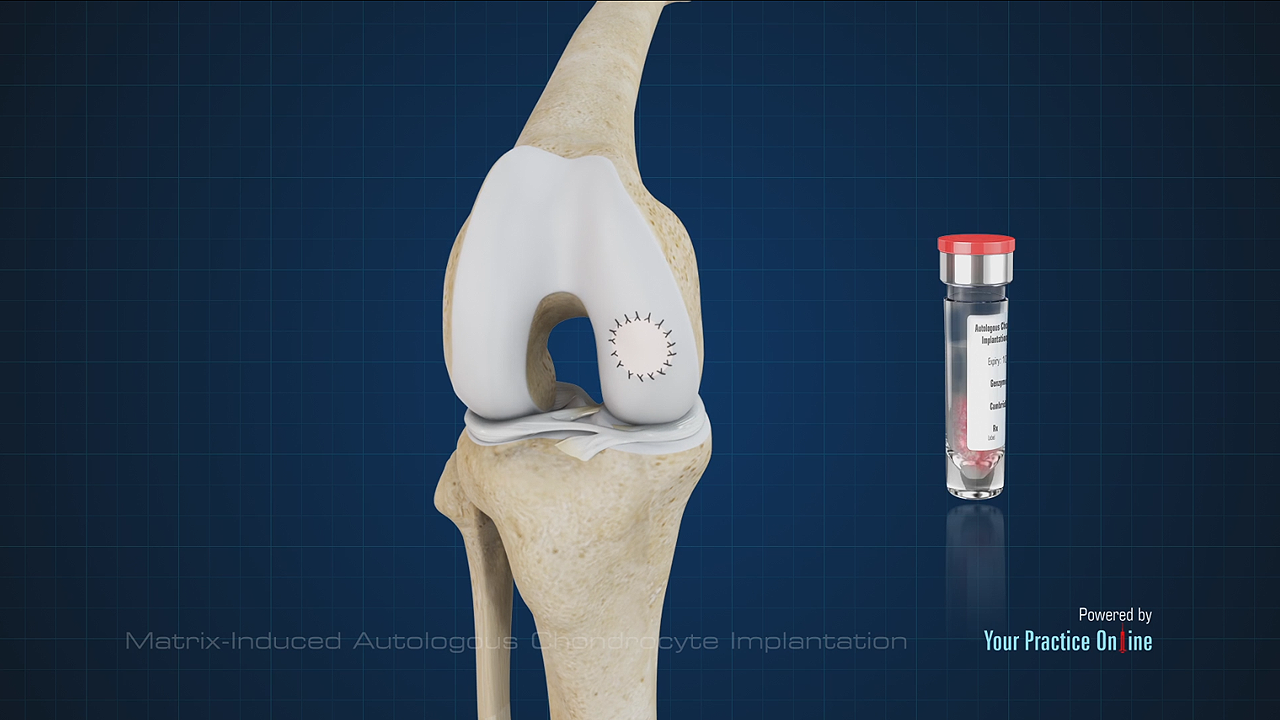 Matrix-Induced Autologous Chondrocyte Implantation Video | Medical ...