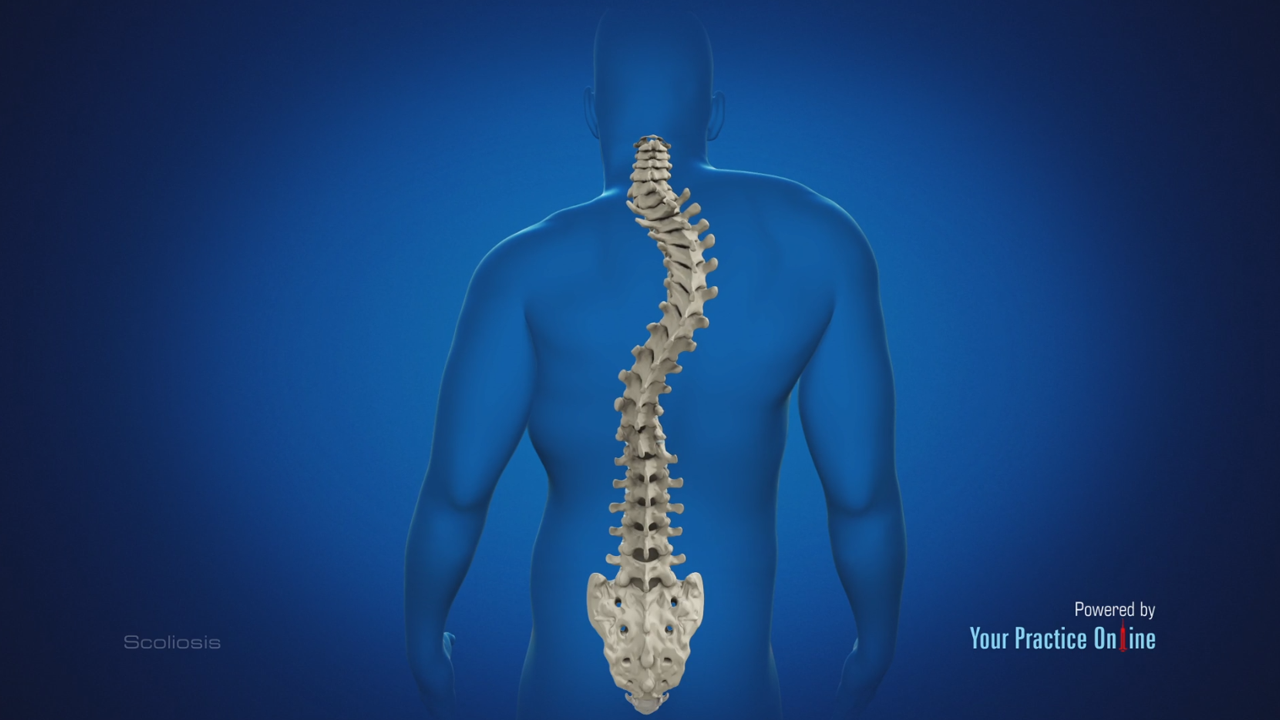 Scoliosis Video | Medical Video Library