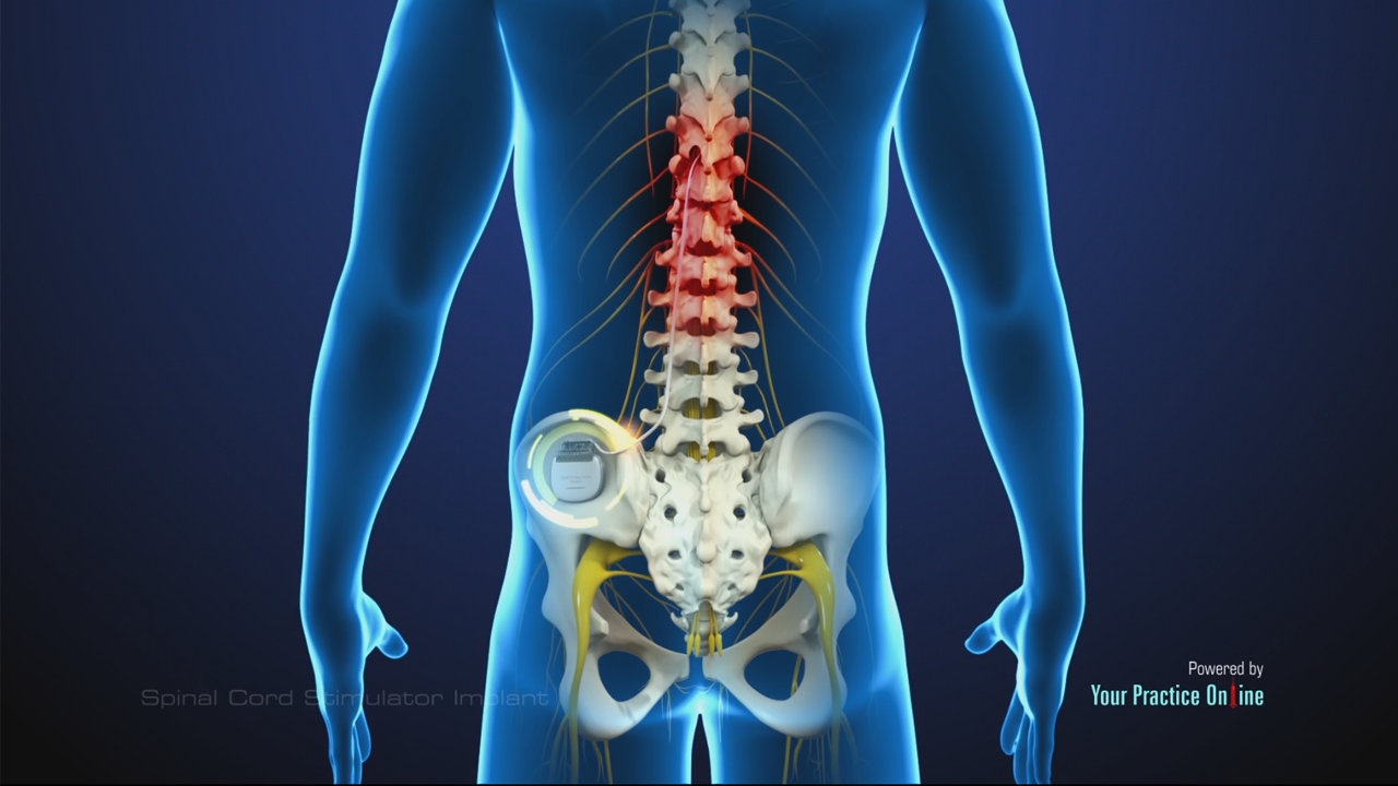 abbott spinal cord stimulator burst