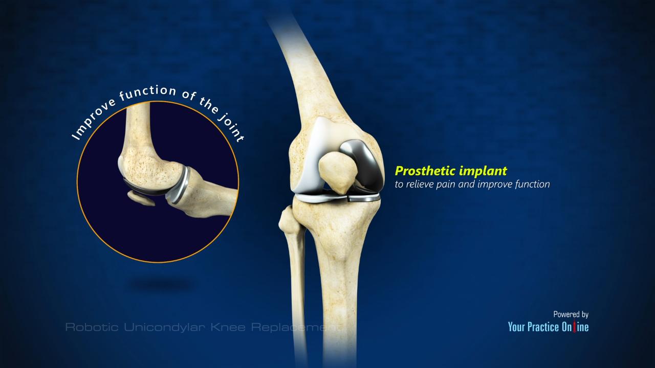 Robotic Unicondylar Knee Replacement Video | Medical Video Library