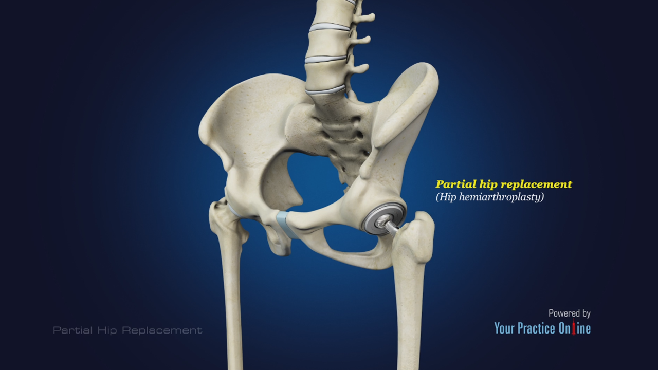 Partial Hip Replacement Video | Medical Video Library