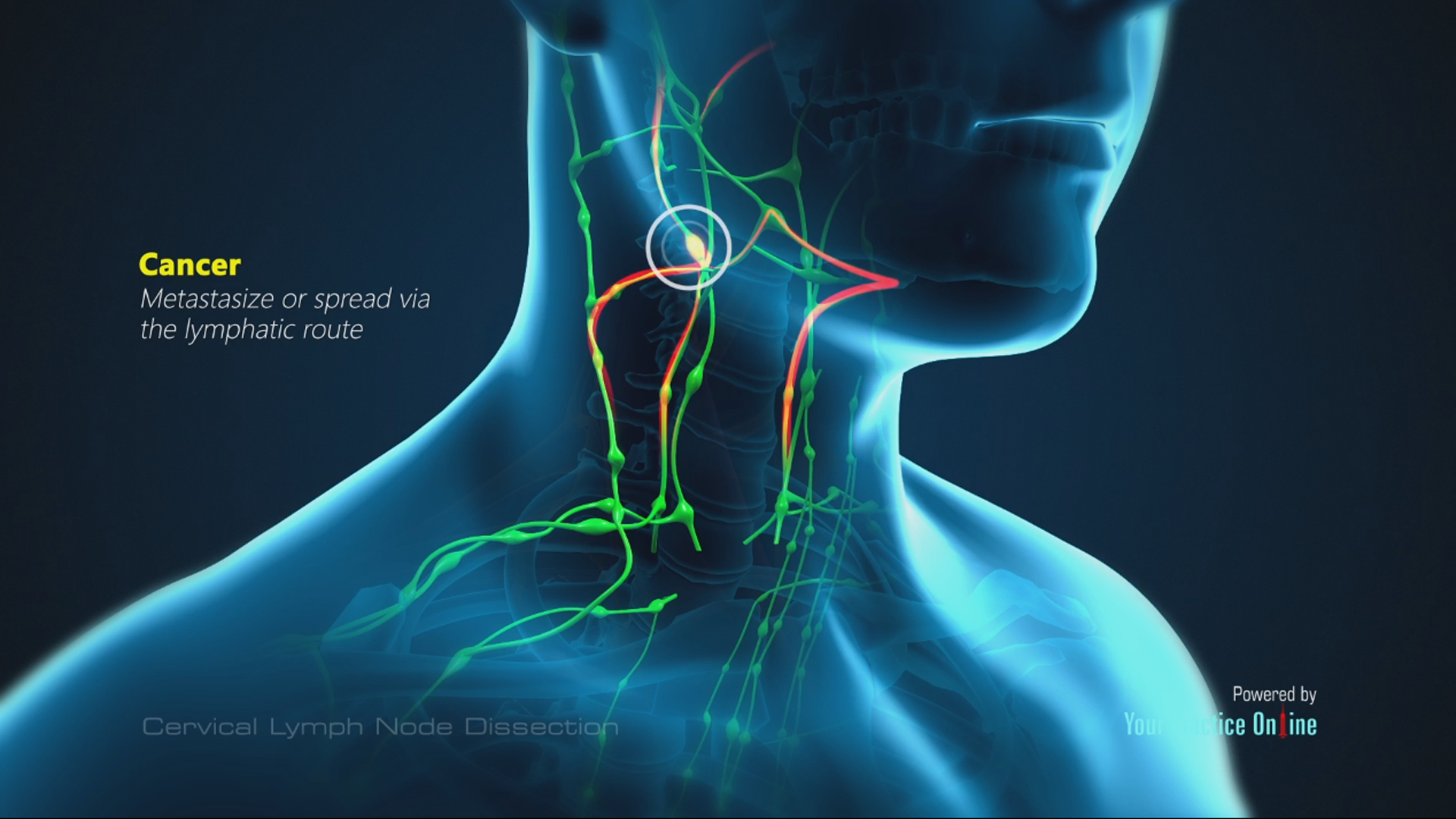 lymph node in back of neck