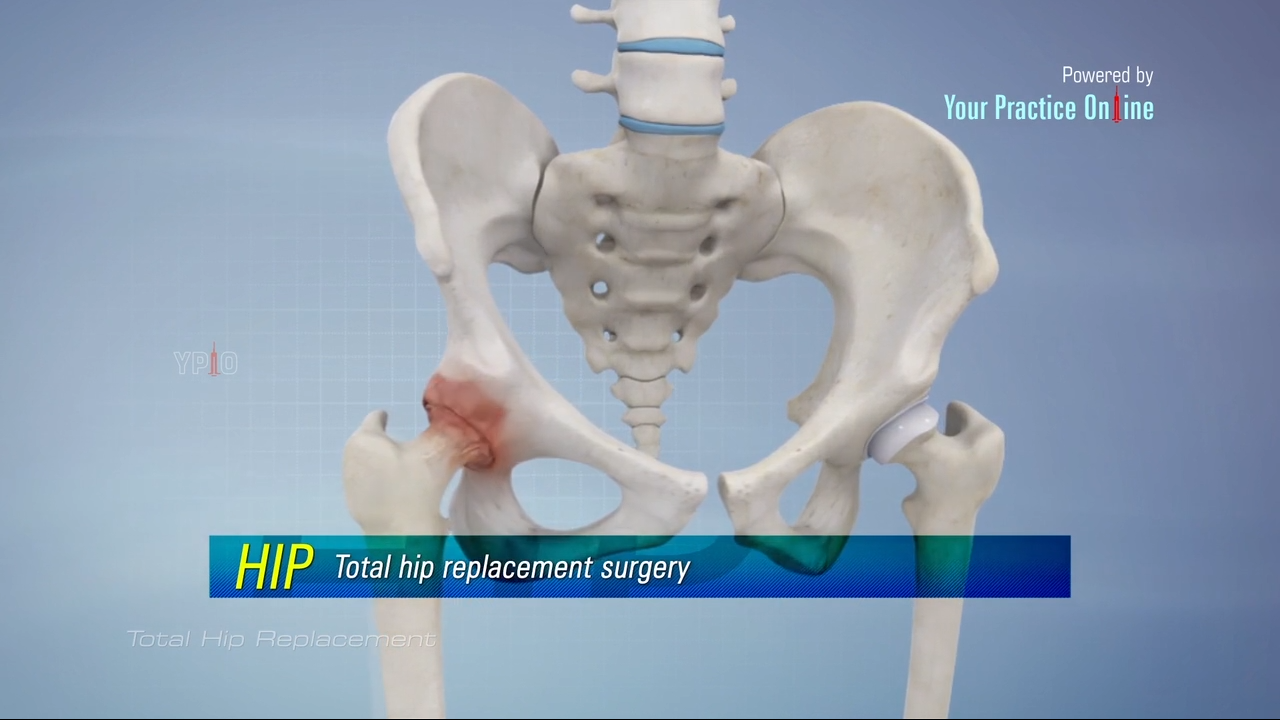 Total Hip Replacement Surgery Video | Hip Orthopaedics Videos ...