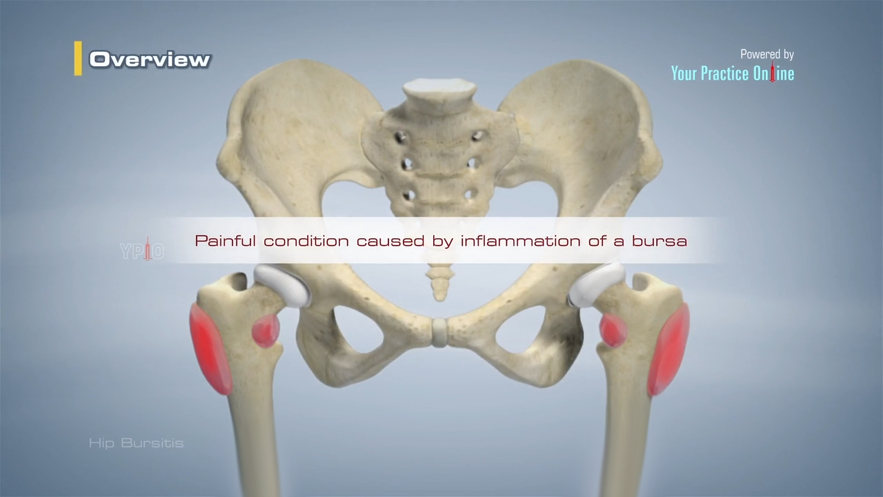 Hip Bursitis Video | Hip Orthopaedics Videos | Your Practice ...