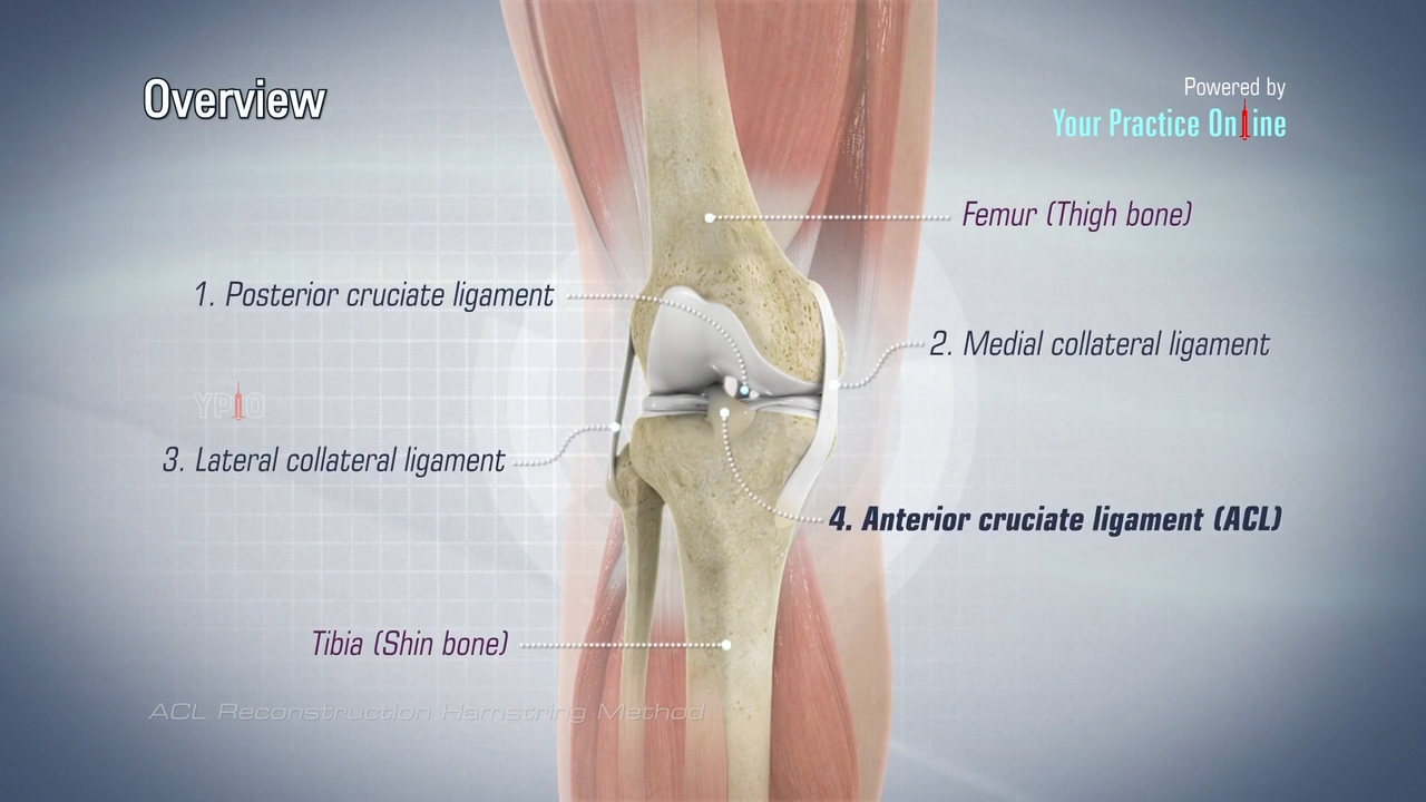ACL Reconstruction Hamstring Method Video, Knee Surgery Videos