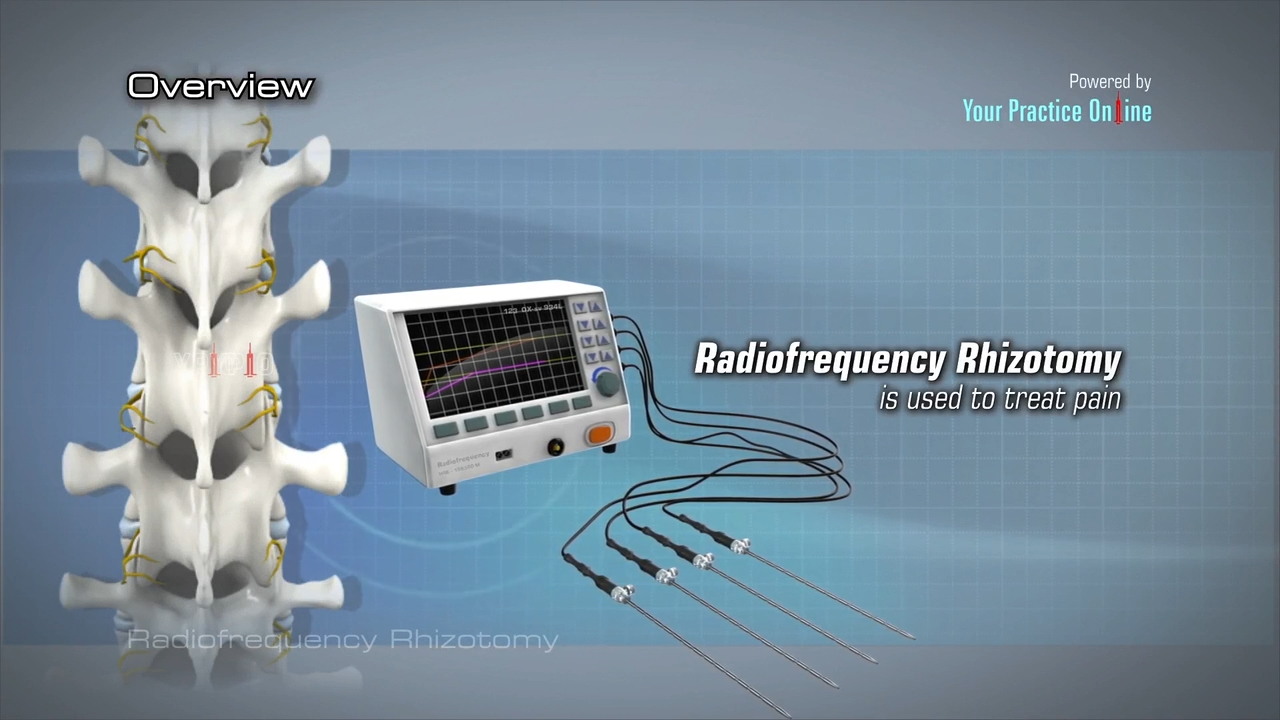 Rhizotomy Video | Medical Video Library