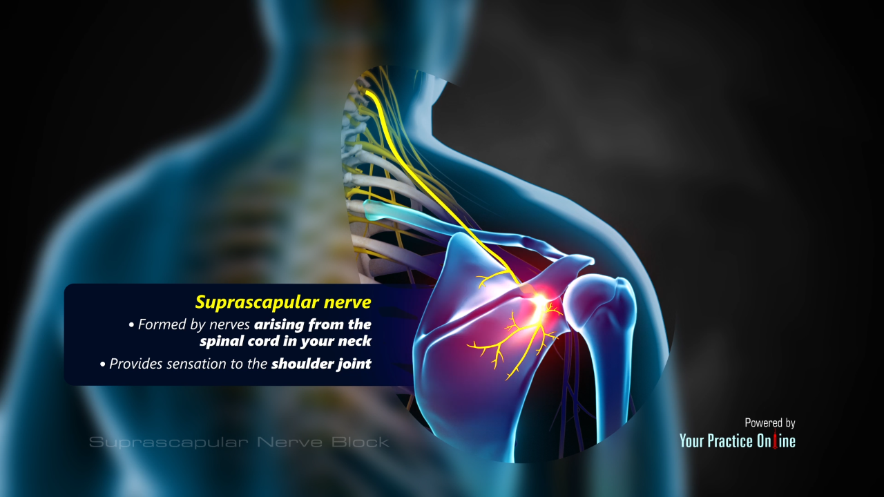 dorsal scapular nerve entrapment