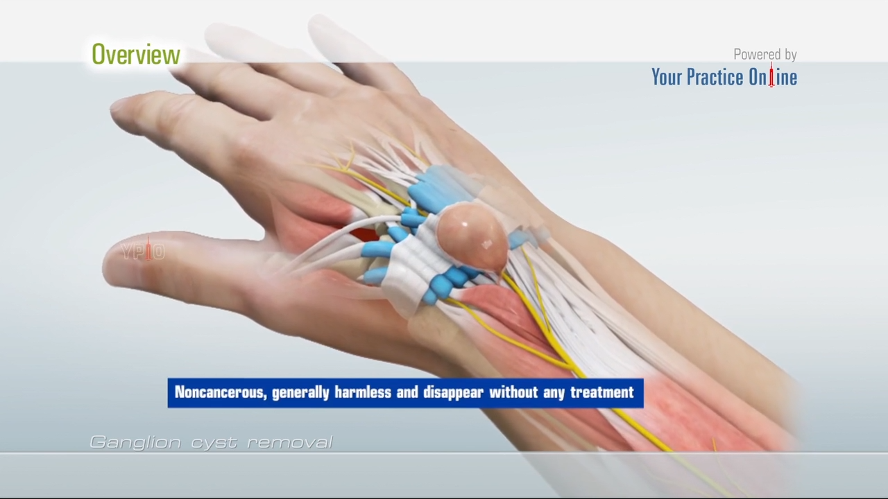 What to Do If You Have a Ganglion Cyst