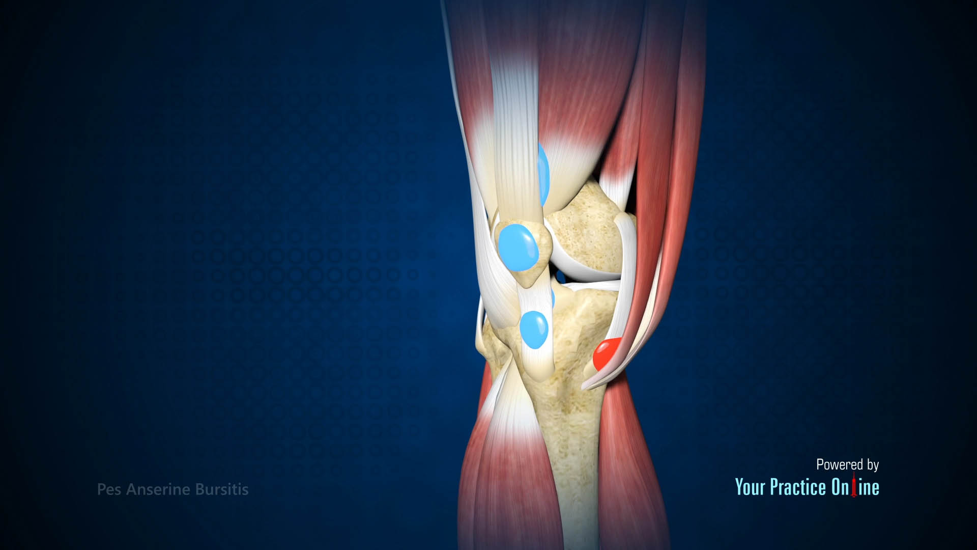 Pes Anserine Bursitis Video Medical Video Library