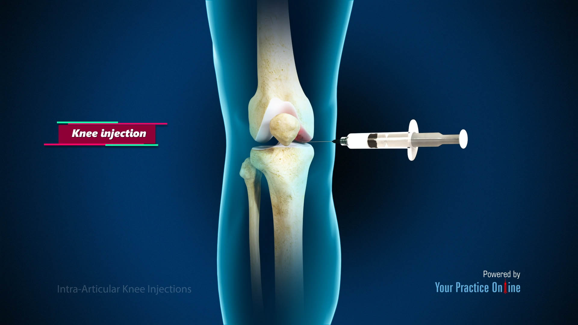 Intra-articular Knee Injections Video | Medical Video Library