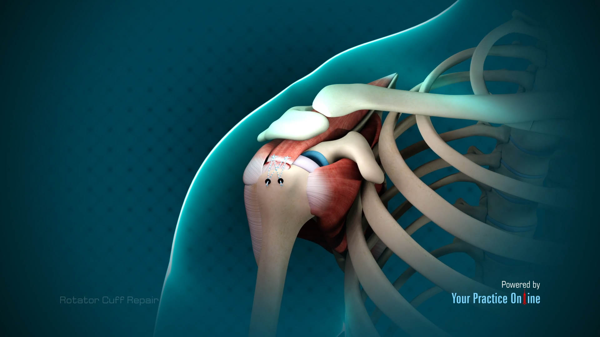 Rotator Cuff Repair Video | Medical Video Library