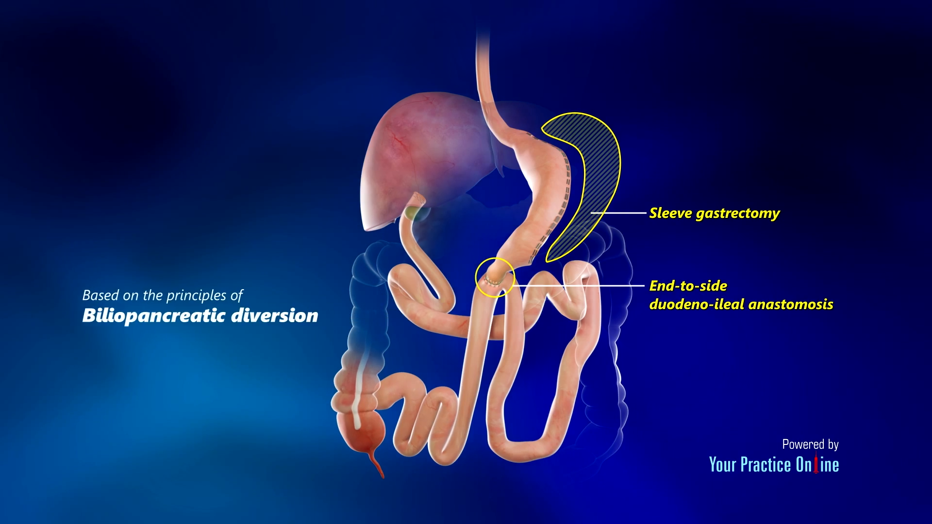 Single Anastomosis Duodeno-ileal Bypass with Sleeve Gastrectomy (SADI-S ...