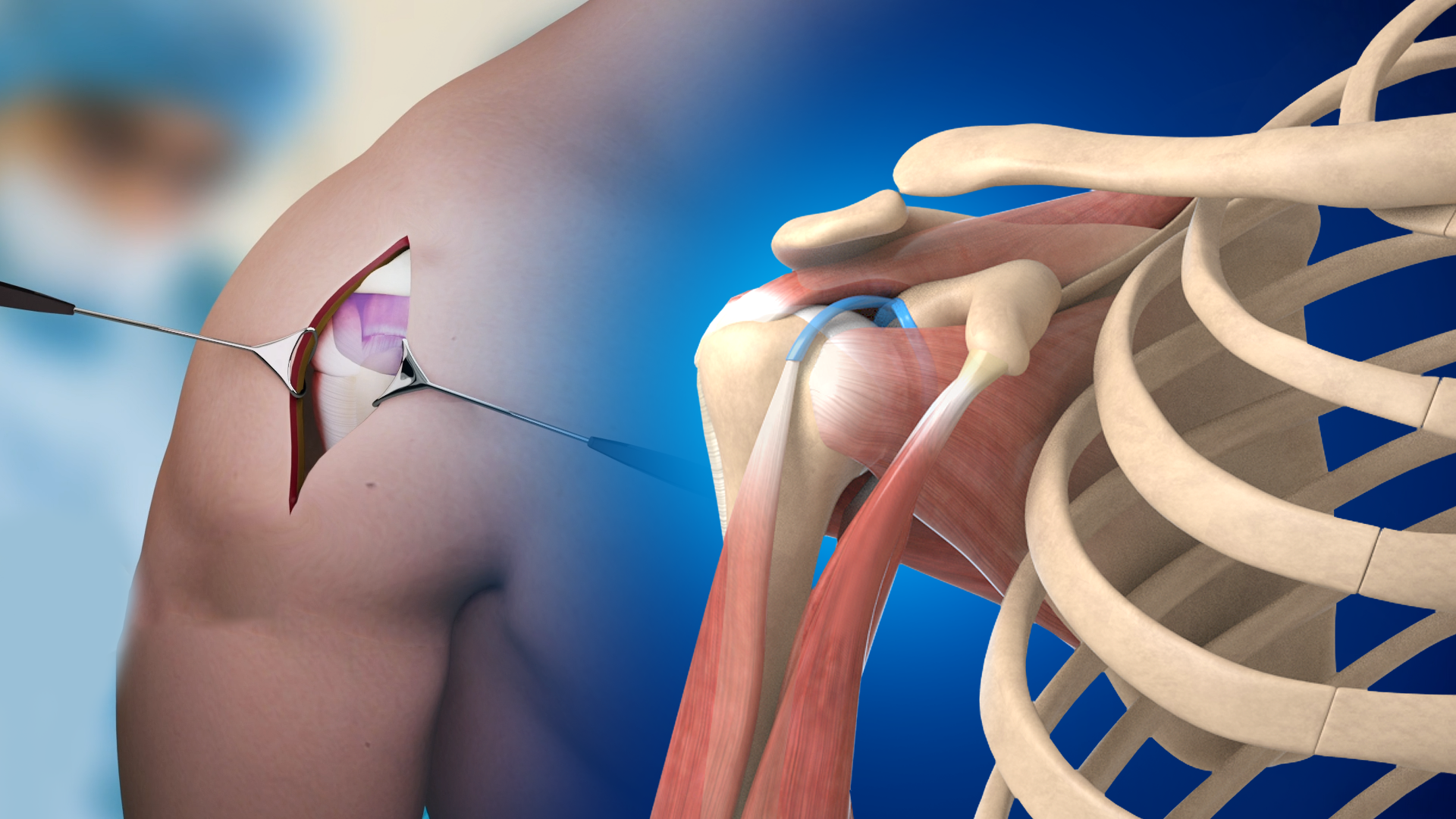 Shoulder Impingement Video Medical Video Library