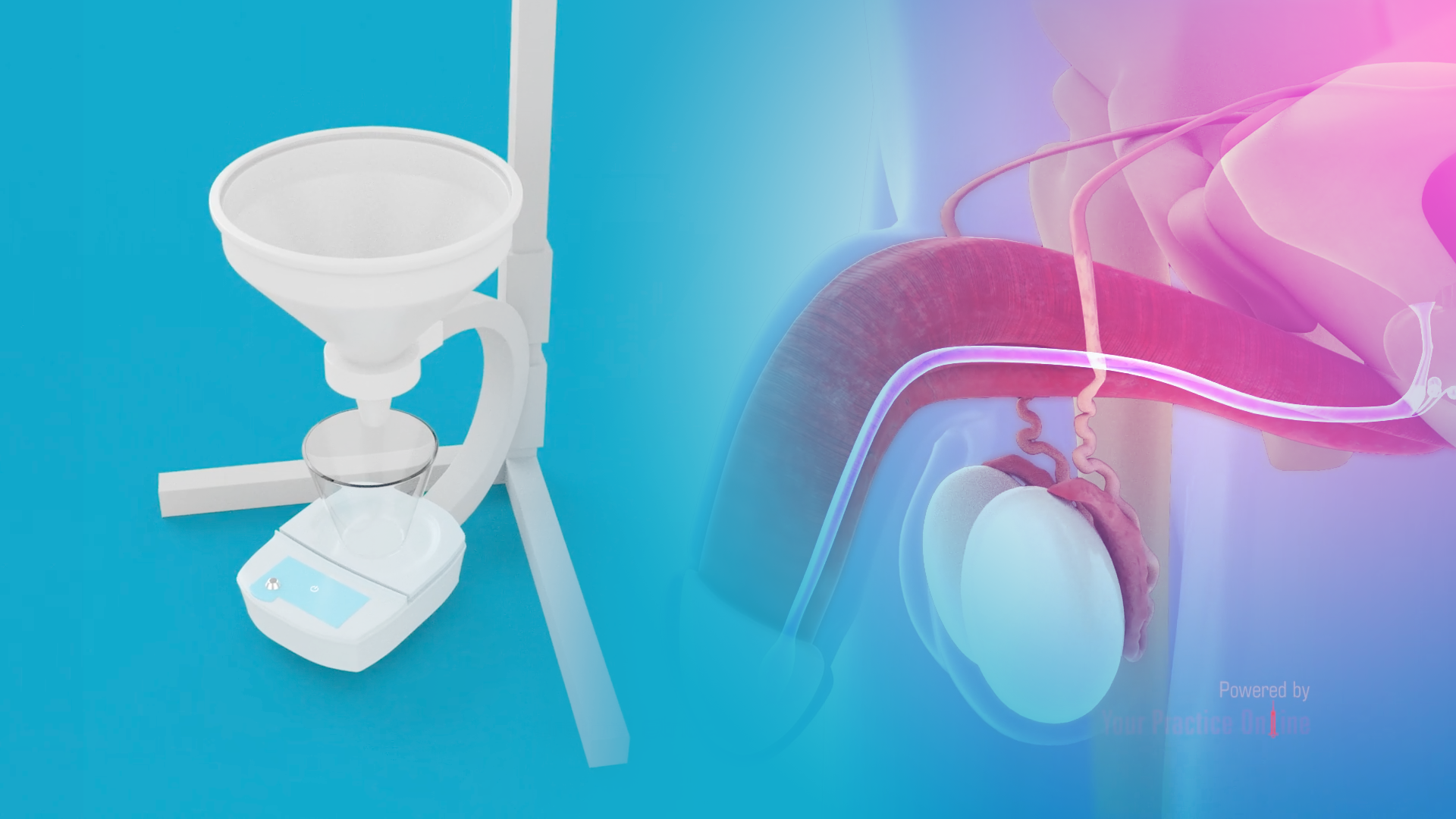 Urethral Stricture