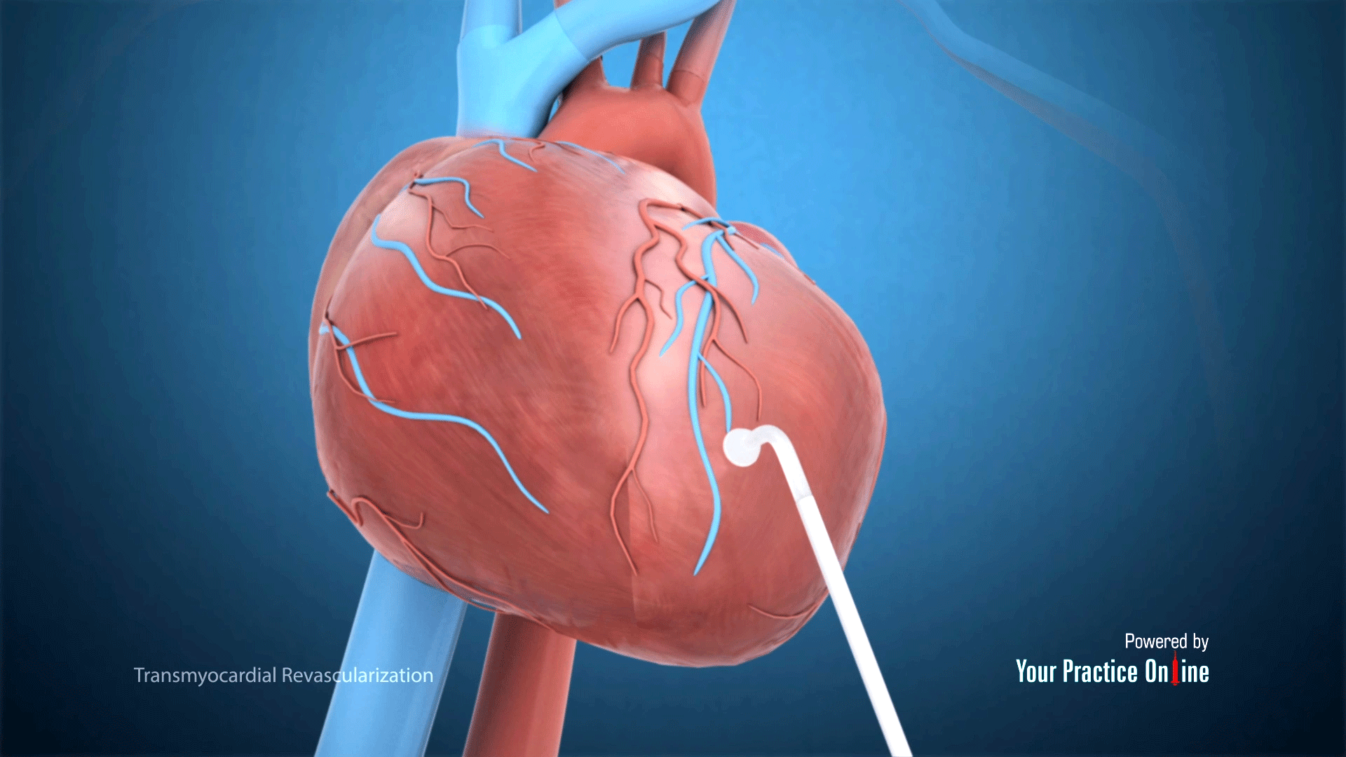 Transmyocardial Revascularization TMR Video Medical Video Library