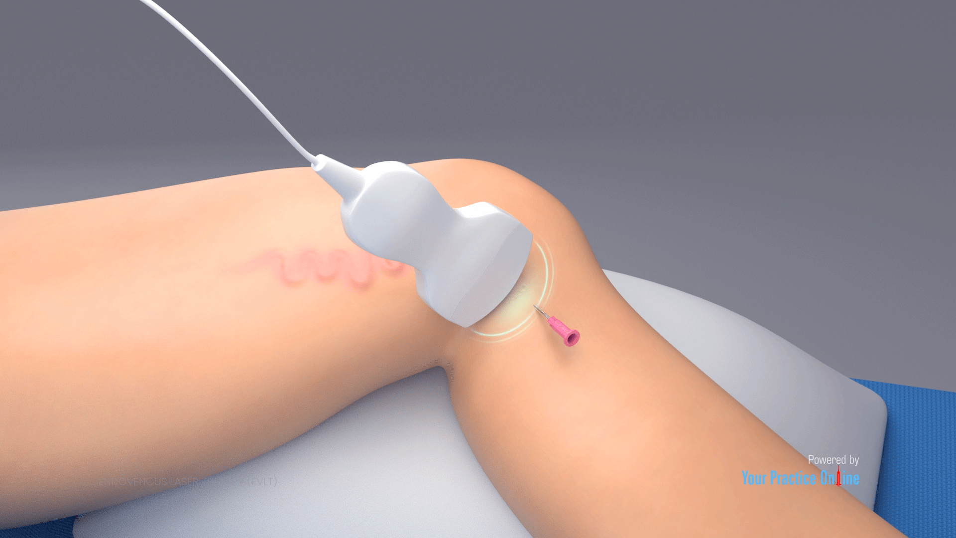 Endovenous Ablation Vein Treatment, Fort Myers