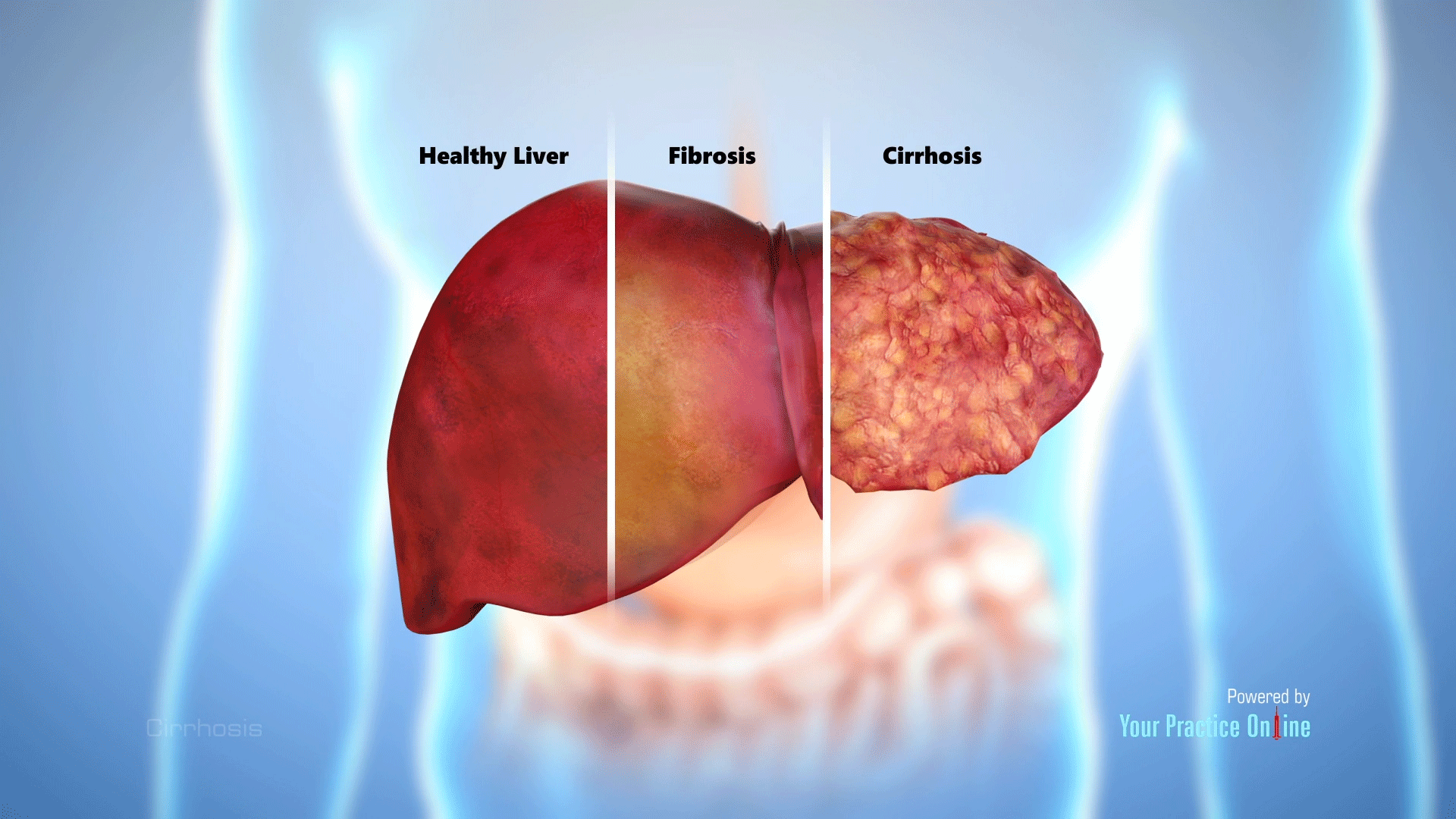 liver cirrhosis symptoms skin