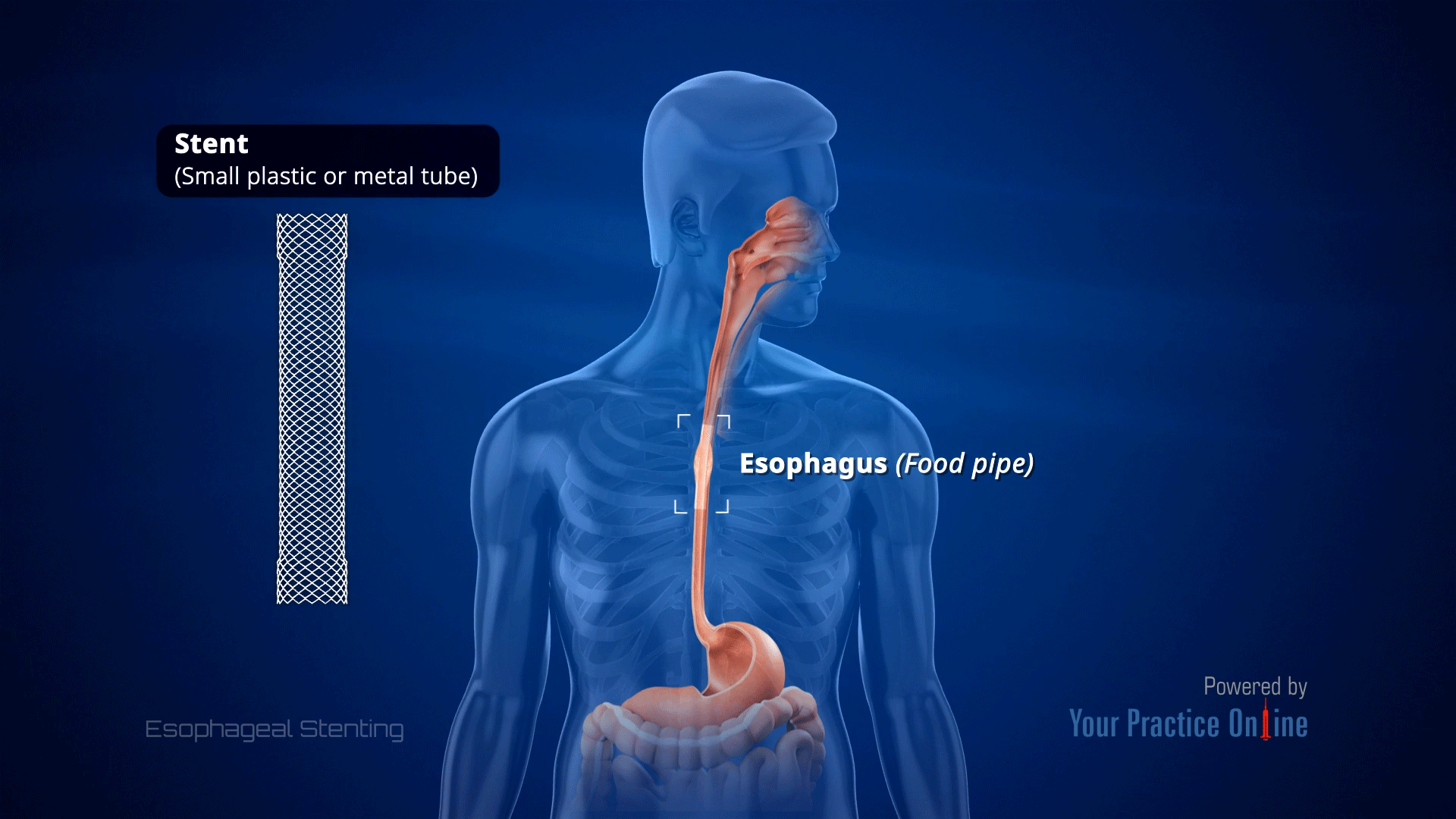 Esophageal Stenting Video Medical Video Library