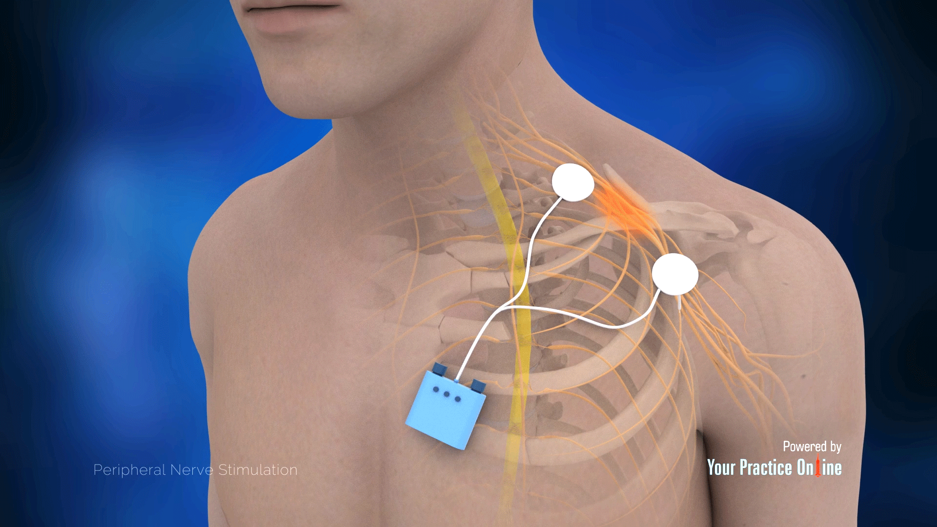 a peripheral nerve or dorsal column stimulator