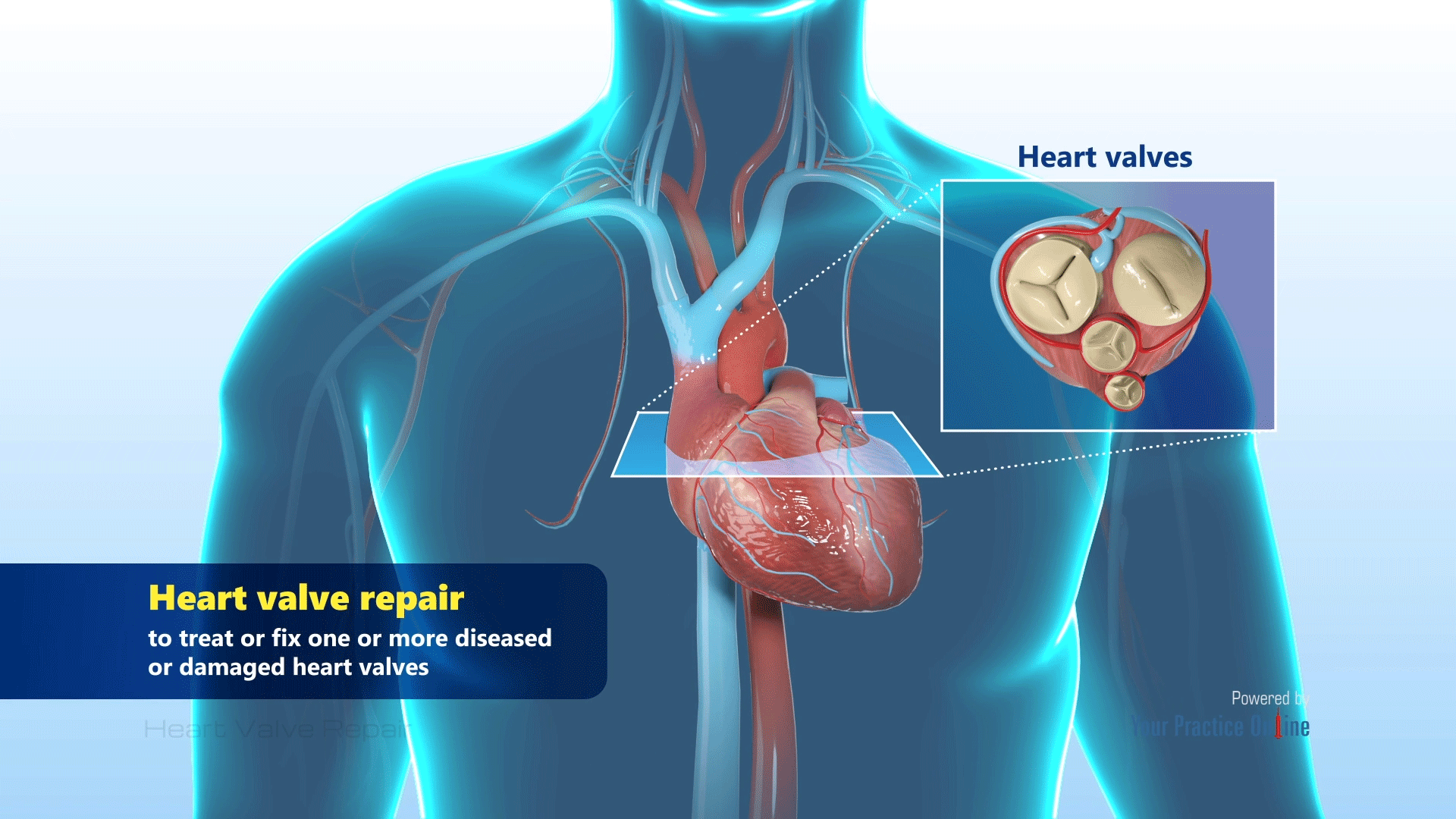 Heart Valve Repair Video | Medical Video Library