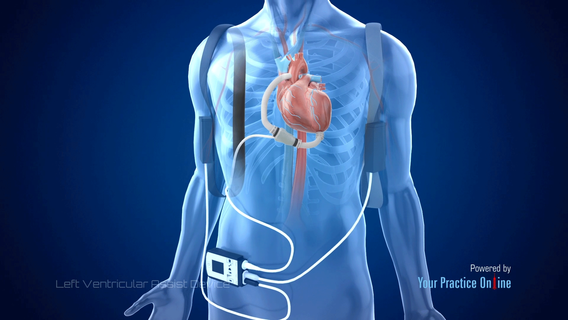 Left Ventricular Assist Device (LVAD) Video | Medical Video Library