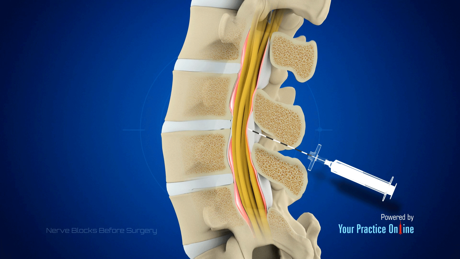 Nerve Blocks Before Surgery Video | Medical Video Library