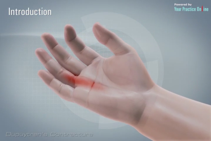 Dupuytrens Contracture | Hand & Wrist Orthopaedics Videos | Your ...