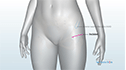 Bikini Incision Hip Replacement