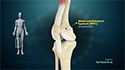 Medial Patellofemoral Ligament (MPFL) Reconstruction