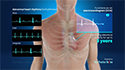 Cardiac Loop Recorder Implantation